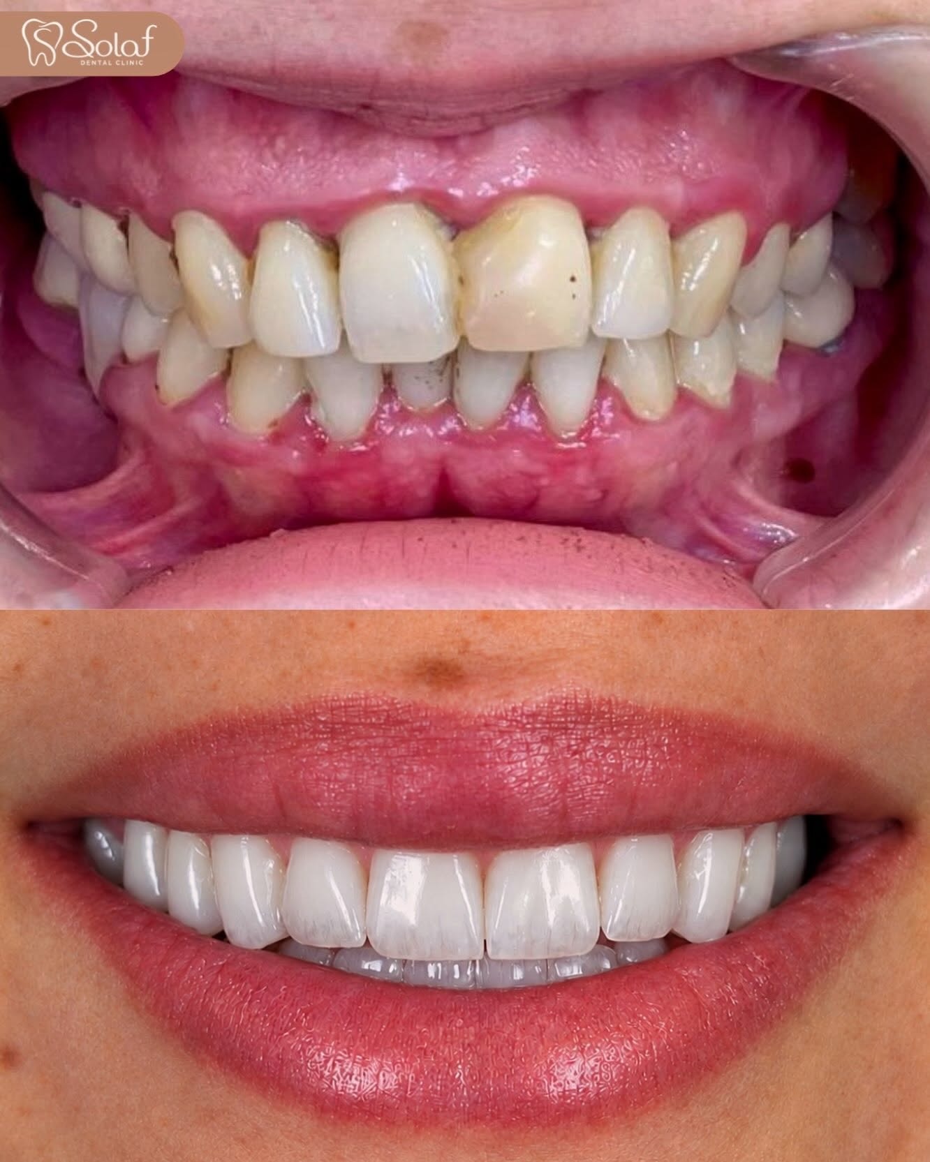 Zirconia Crowns with Gum Treatment