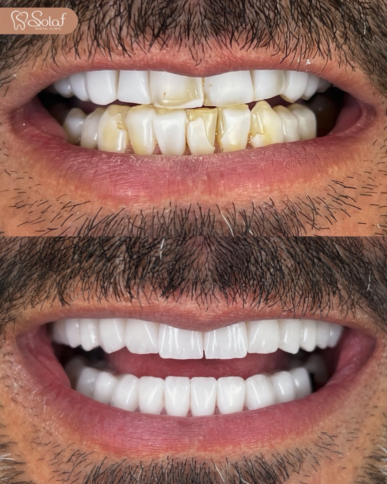 إعادة تصميم الابتسامة بالفينير