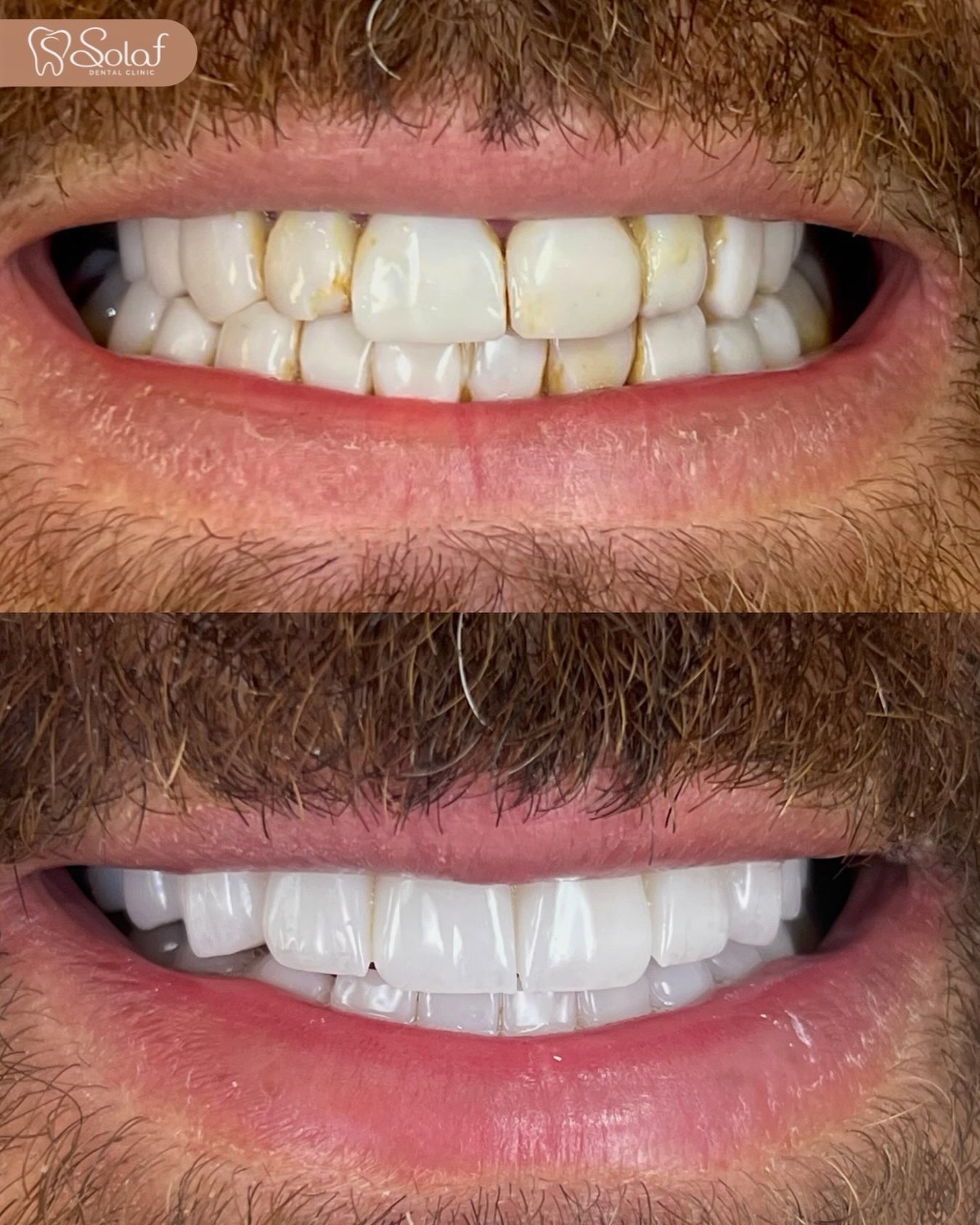 Smile Rehabilitation with Zirconia